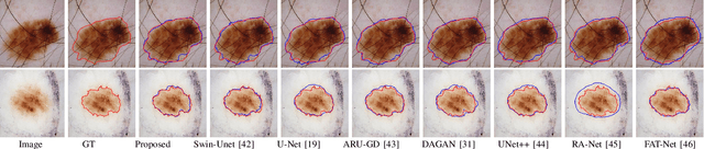 Figure 3 for TESL-Net: A Transformer-Enhanced CNN for Accurate Skin Lesion Segmentation