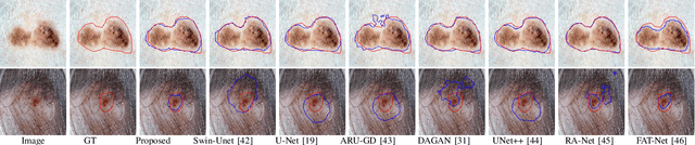 Figure 4 for TESL-Net: A Transformer-Enhanced CNN for Accurate Skin Lesion Segmentation