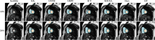 Figure 3 for SP${ }^3$ : Superpixel-propagated pseudo-label learning for weakly semi-supervised medical image segmentation