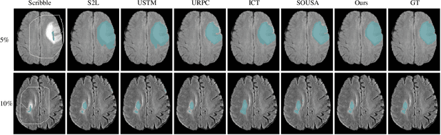 Figure 4 for SP${ }^3$ : Superpixel-propagated pseudo-label learning for weakly semi-supervised medical image segmentation
