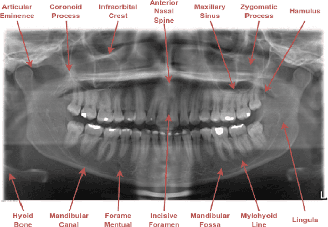 Figure 1 for Semi-supervised classification of dental conditions in panoramic radiographs using large language model and instance segmentation: A real-world dataset evaluation