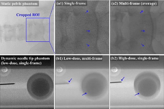 Figure 1 for Unsupervised Training of a Dynamic Context-Aware Deep Denoising Framework for Low-Dose Fluoroscopic Imaging