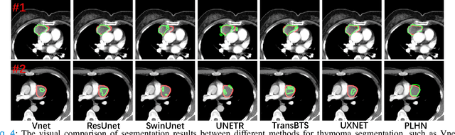 Figure 4 for Prototype Learning Guided Hybrid Network for Breast Tumor Segmentation in DCE-MRI