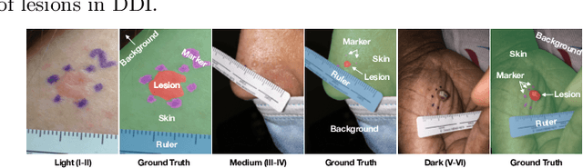 Figure 2 for FEDD -- Fair, Efficient, and Diverse Diffusion-based Lesion Segmentation and Malignancy Classification