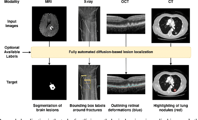 Figure 1 for Denoising Diffusion Models for Anomaly Localization in Medical Images