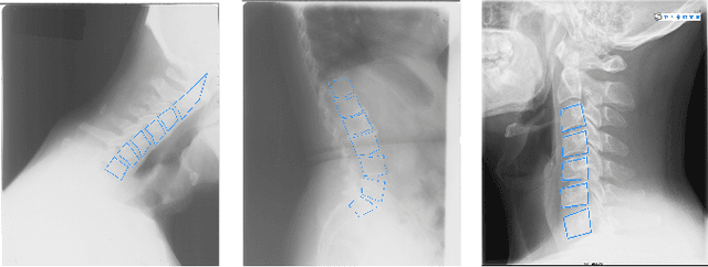 Figure 1 for SpineFM: Leveraging Foundation Models for Automatic Spine X-ray Segmentation