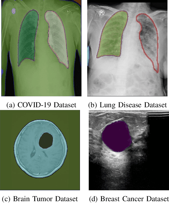 Figure 3 for MedFocusCLIP : Improving few shot classification in medical datasets using pixel wise attention