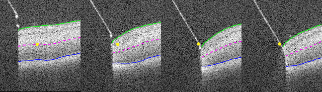 Figure 1 for Real-time Deformation-aware Control for Autonomous Robotic Subretinal Injection under iOCT Guidance