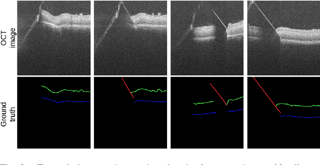 Figure 3 for Real-time Deformation-aware Control for Autonomous Robotic Subretinal Injection under iOCT Guidance