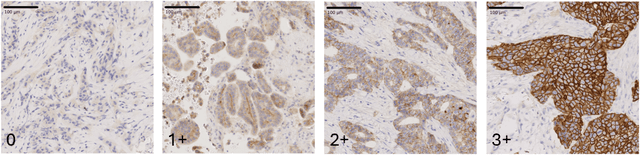 Figure 1 for Mimicking a Pathologist: Dual Attention Model for Scoring of Gigapixel Histology Images