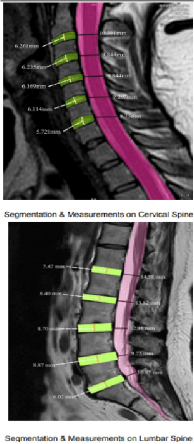 Figure 4 for AI and Deep Learning for Automated Segmentation and Quantitative Measurement of Spinal Structures in MRI