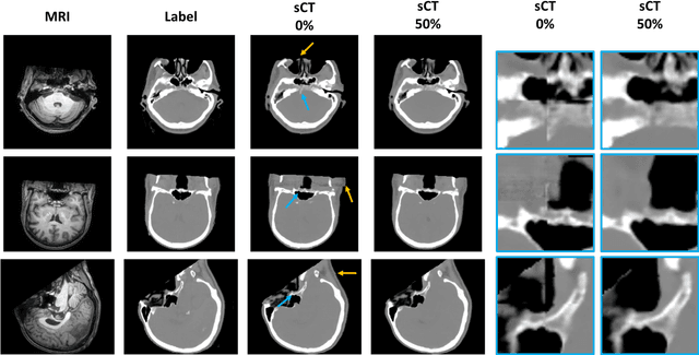 Figure 3 for Enhancing Cross-Modality Synthesis: Subvolume Merging for MRI-to-CT Conversion