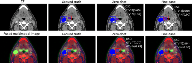 Figure 2 for Segment anything model for head and neck tumor segmentation with CT, PET and MRI multi-modality images