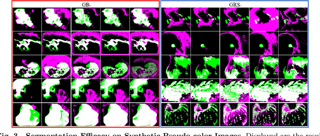 Figure 3 for Enhancing Diagnostic Precision in Gastric Bleeding through Automated Lesion Segmentation: A Deep DuS-KFCM Approach