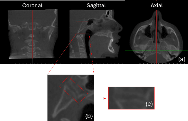 Figure 1 for Knowledge Distillation Approach for SOS Fusion Staging: Towards Fully Automated Skeletal Maturity Assessment