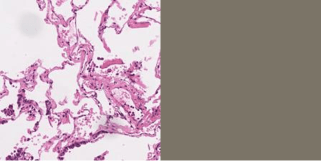 Figure 3 for FedDP: Privacy-preserving method based on federated learning for histopathology image segmentation