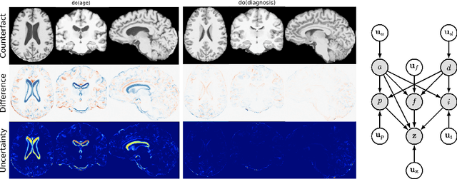 Figure 3 for Latent 3D Brain MRI Counterfactual