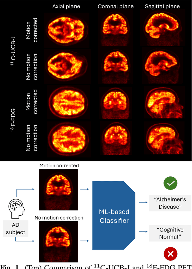 Figure 1 for Head Motion Degrades Machine Learning Classification of Alzheimer's Disease from Positron Emission Tomography