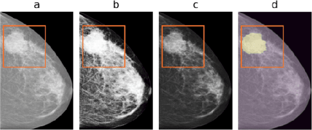 Figure 1 for Learning using privileged information for segmenting tumors on digital mammograms