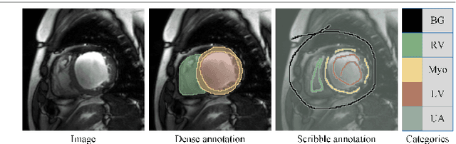 Figure 1 for ScribbleVS: Scribble-Supervised Medical Image Segmentation via Dynamic Competitive Pseudo Label Selection