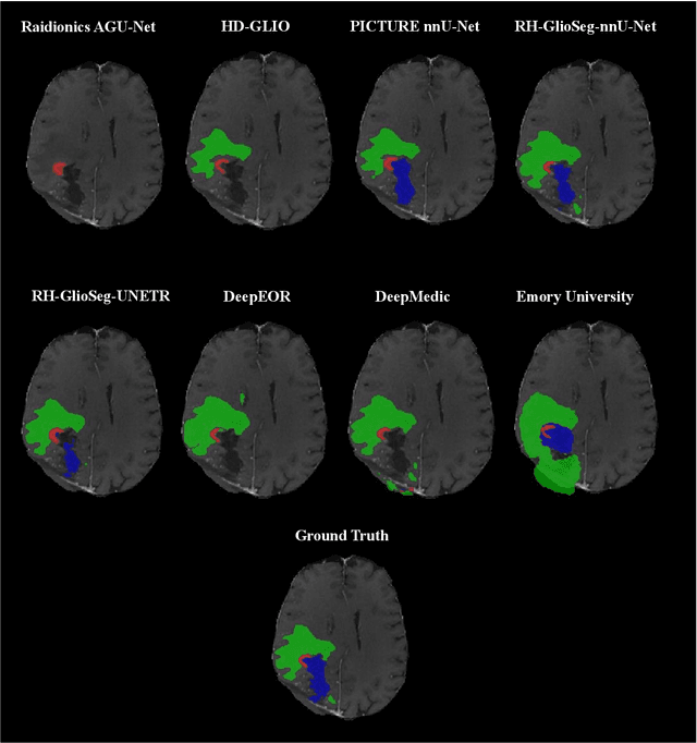 Figure 2 for Postoperative glioblastoma segmentation: Development of a fully automated pipeline using deep convolutional neural networks and comparison with currently available models