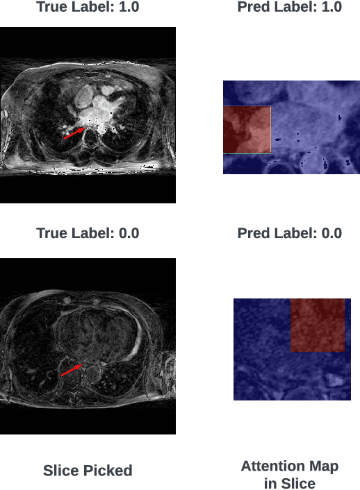 Figure 2 for HAMIL-QA: Hierarchical Approach to Multiple Instance Learning for Atrial LGE MRI Quality Assessment