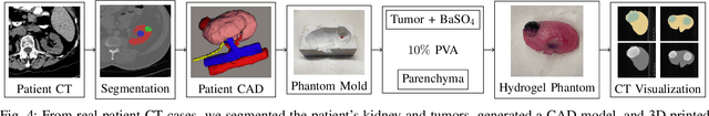 Figure 4 for Tracking Tumors under Deformation from Partial Point Clouds using Occupancy Networks