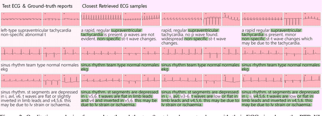 Figure 2 for Electrocardiogram Report Generation and Question Answering via Retrieval-Augmented Self-Supervised Modeling