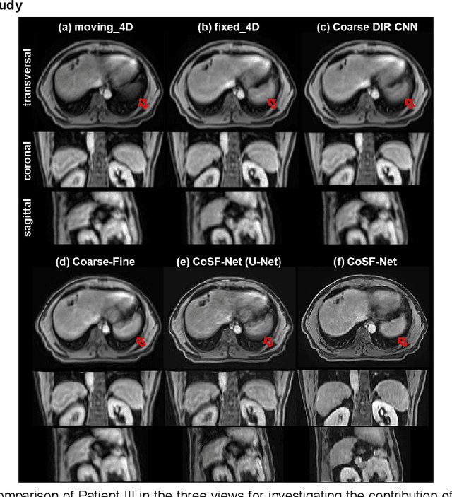 Figure 4 for Coarse-Super-Resolution-Fine Network (CoSF-Net): A Unified End-to-End Neural Network for 4D-MRI with Simultaneous Motion Estimation and Super-Resolution