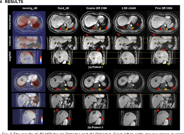 Figure 3 for Coarse-Super-Resolution-Fine Network (CoSF-Net): A Unified End-to-End Neural Network for 4D-MRI with Simultaneous Motion Estimation and Super-Resolution