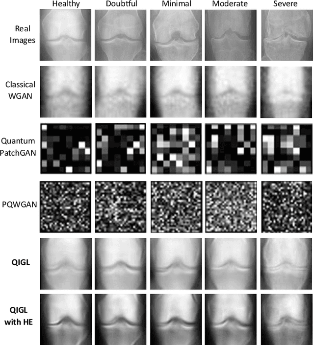 Figure 2 for Quantum Generative Learning for High-Resolution Medical Image Generation