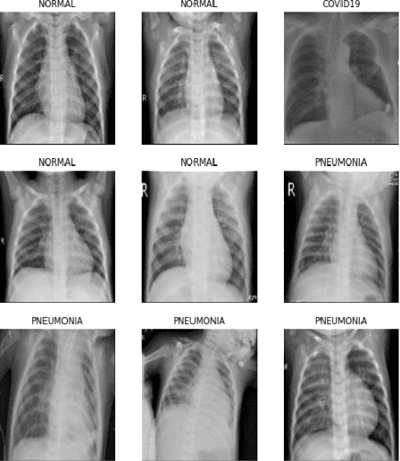 Figure 3 for MIC: Medical Image Classification Using Chest X-ray (COVID-19 and Pneumonia) Dataset with the Help of CNN and Customized CNN