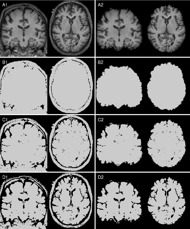 Figure 2 for Pfungst and Clever Hans: Identifying the unintended cues in a widely used Alzheimer's disease MRI dataset using explainable deep learning