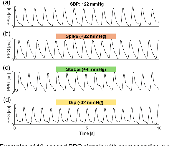 Figure 1 for Using Photoplethysmography to Detect Real-time Blood Pressure Changes with a Calibration-free Deep Learning Model