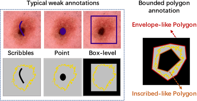 Figure 1 for EAUWSeg: Eliminating annotation uncertainty in weakly-supervised medical image segmentation