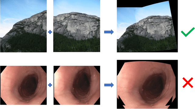 Figure 1 for Enhanced Feature-based Image Stitching for Endoscopic Videos in Pediatric Eosinophilic Esophagitis