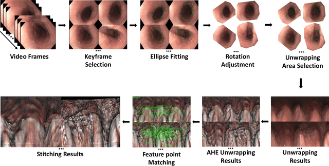 Figure 3 for Enhanced Feature-based Image Stitching for Endoscopic Videos in Pediatric Eosinophilic Esophagitis