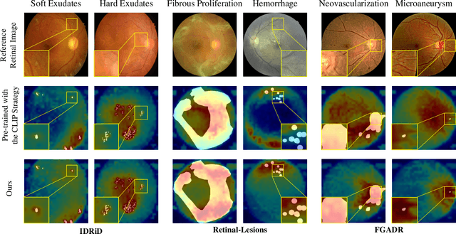 Figure 3 for ViLReF: A Chinese Vision-Language Retinal Foundation Model