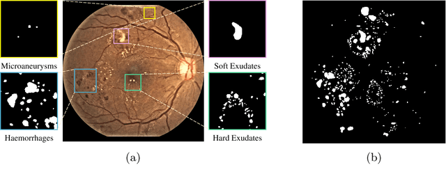 Figure 1 for Cross Feature Fusion of Fundus Image and Generated Lesion Map for Referable Diabetic Retinopathy Classification