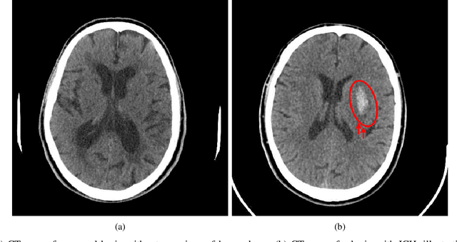Figure 2 for AI-Powered Intracranial Hemorrhage Detection: A Co-Scale Convolutional Attention Model with Uncertainty-Based Fuzzy Integral Operator and Feature Screening