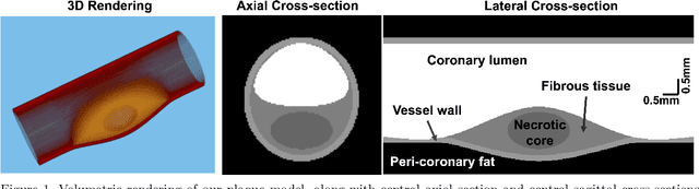 Figure 1 for Coronary Atherosclerotic Plaque Characterization with Photon-counting CT: a Simulation-based Feasibility Study