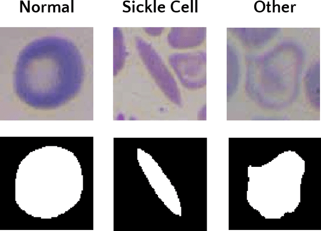 Figure 3 for Improving Sickle Cell Disease Classification: A Fusion of Conventional Classifiers, Segmented Images, and Convolutional Neural Networks