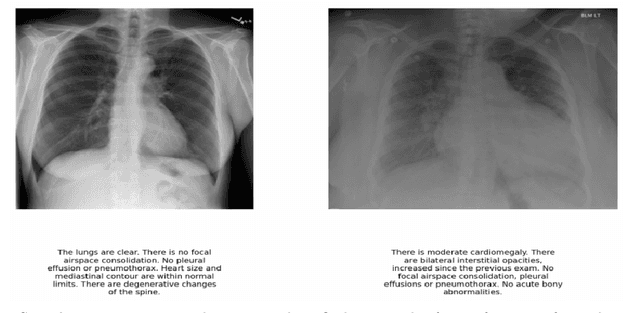 Figure 3 for Vision-Language Models for Automated Chest X-ray Interpretation: Leveraging ViT and GPT-2