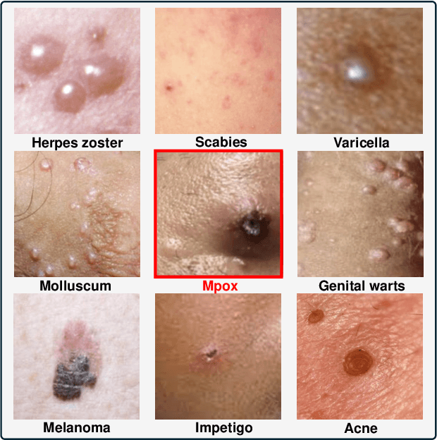 Figure 1 for MpoxVLM: A Vision-Language Model for Diagnosing Skin Lesions from Mpox Virus Infection