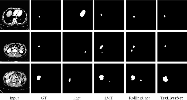Figure 3 for TexLiverNet: Leveraging Medical Knowledge and Spatial-Frequency Perception for Enhanced Liver Tumor Segmentation