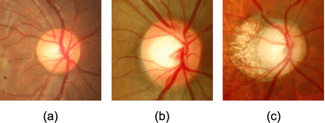 Figure 1 for GS-Net: Global Self-Attention Guided CNN for Multi-Stage Glaucoma Classification