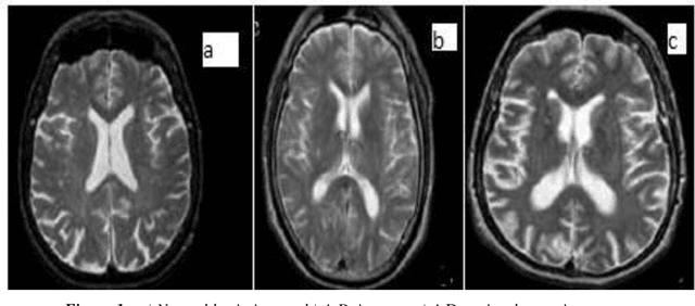 Figure 2 for Exploring the Efficacy of Group-Normalization in Deep Learning Models for Alzheimer's Disease Classification