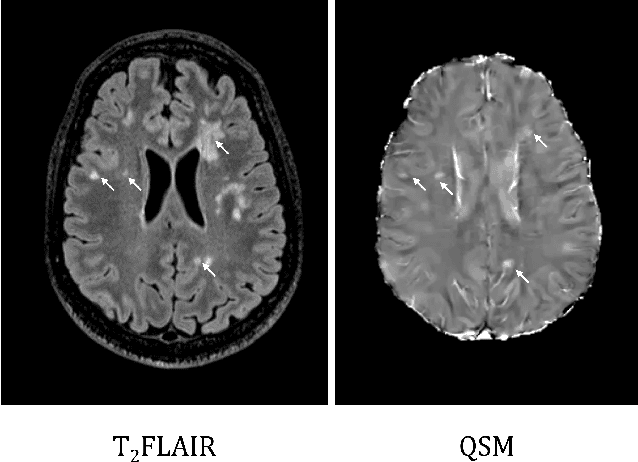 Figure 1 for Synthetic Generation and Latent Projection Denoising of Rim Lesions in Multiple Sclerosis