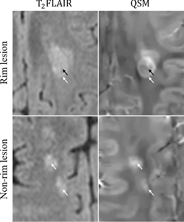 Figure 3 for Synthetic Generation and Latent Projection Denoising of Rim Lesions in Multiple Sclerosis