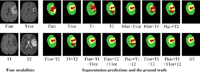 Figure 1 for A Multimodal Feature Distillation with CNN-Transformer Network for Brain Tumor Segmentation with Incomplete Modalities